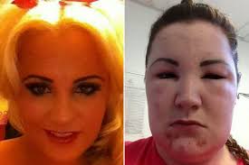 Most professional colorists i know avoid. Khloe Kardashian Wannabe Mum Left Looking Like The Elephant Man After Hair Dye Allergic Reaction Irish Mirror Online