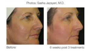 eMatrix Sublative Skin Rejuvenation