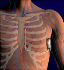 Image result for Internal Cardiac Defibrillator
