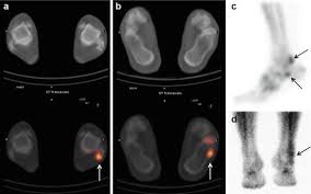 Haglund deformity, also known as a pump bump, bauer bump, or mulholland deformity, is defined as bony enlargement formed at the posterosuperior aspect of the calcaneum. Nuclear Medicine Imaging Of Foot Injuries Radiology Key