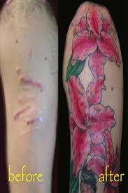 They rise above the rest of the skin and usually have a smooth top, are rough to the touch, and have a pink. Assisting The World In The Battle Of Scar Removal Helpful Tips Home Remedies Tattoo Over Scar Cover Scar Cover Tattoo