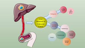 With stage 3 colon cancer, there will be a positive finding of a primary tumor and regionally affected lymph nodes but no signs of metastasis. Mechanisms And Treatment Progress On Liver Metastasis Ott