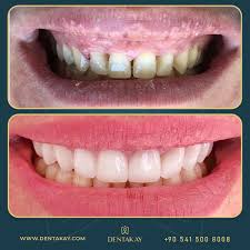 Should zirconia crowns be bonded or cemented to the teeth? Successfully Done 10 Zirconia Crowns For Our Dear Patient Helping Her Smile Again Cosmetic Dentistry Healthy Teeth Tooth Crown