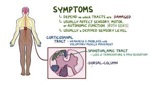 Image result for Myelitis