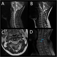 Tm is characterized by weakness and numbness of the limbs. Subacute Transverse Myelitis With Optic Symptoms In Neuroborreliosis A Case Report Bmc Neurology Full Text