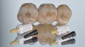 We did not find results for: Ceramic Dental Implants Innovation In Dentistry Innovation News Network