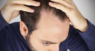 So wie sich mit zunehmendem alter die körperkräfte erschöpfen, erschöpft sich auch die. Anlagebedingter Haarausfall Androgenetische Alopezie Symptome Therapie Apotheken Umschau