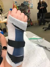 Image result for Ulnar Gutter Cast