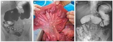 Image result for Midgut Volvulus