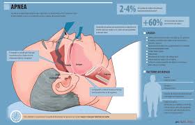 Apnea Del Sueno Ahogos En Suenos Peligro De Enfermedad Salud Ediciones