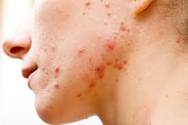 acne vulgaris ile ilgili görsel sonucu