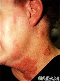 Shingles Medlineplus Medical Encyclopedia