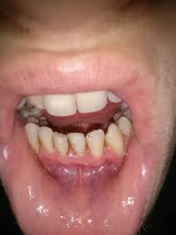 Brown Edges Of Front Bottom Teeth Dentistry