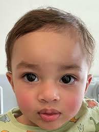 Photograph at postoperative 9 months follow-up, demonstrating complete...