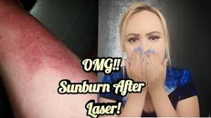 You need to know what happens after the laser hair removal procedure: Sun Exposure After Laser Hair Removal 2018 W Pictures Youtube