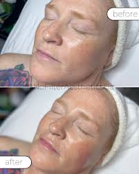 From dull to dang, girl ✨ Swipe to see how our Dermaplane Facial removes  dead skin + peach fuzz for that ultra-smooth, lit-from-within glow. Ready  to feel polished and radiant? Book your