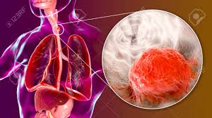 According to a paper from 2009, skin cancer makes up as much as 45% of all cancers in white people, 5% of all cancers in hispanic people, 4% of all cancers in asian people, and 2% of all cancers in black people. Esophageal Cancer 3d Illustration Showing Malignant Tumor In The Human Esophagus Stock Photo Picture And Royalty Free Image Image 128651897