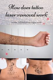 How Does Laser Tattoo Removal Work Infinity Laser Spa Nyc Video Video Laser Tattoo Removal Laser Tattoo Tattoo Removal