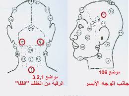 الصداع النصفي الشقيقة Migraine الحجامة