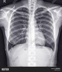 Reference database of normal imaging from birth to age 16. Chest X Ray Female 36 Image Photo Free Trial Bigstock