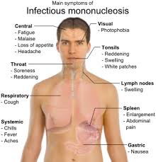 Mononucleosis Your Guide To Health Wealth