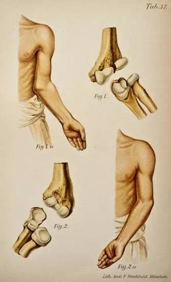 Cubitus Valgus |Turned out Elbow | We treat this condition in Kids