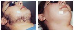 Any additional treatments needed will be at reduced pricing. 10 Before After Laser Hair Removal Ideas Laser Hair Removal Hair Removal Laser Hair