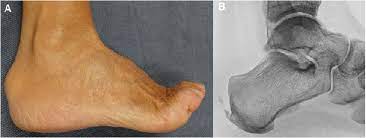 Related online courses on physioplus. How To Treat Haglund S Deformity In Runners Podiatry Today