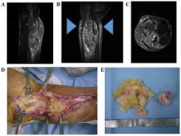 Image result for phlegmon of hand)