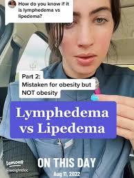 Signs of Lipedema: Identifying Symptoms and Understanding This Condition