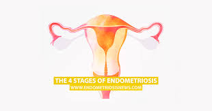 The 4 Stages Of Endometriosis Endometriosis News