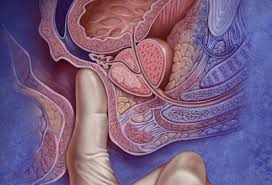 But suggested strategies for preventing prostate cancer include eating. Prostate Cancer Symptoms Pca Test Treatments