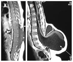 Image result for Spinal Dysraphism