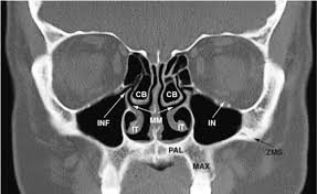 There is a close relation with the optic nerve. Imaging Of The Paranasal Sinuses Ento Key