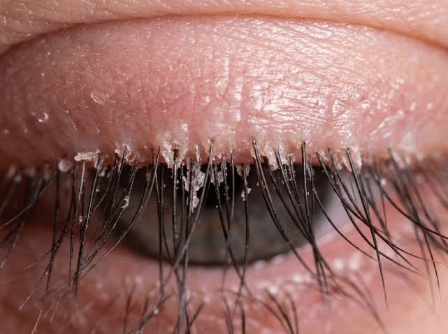 Eyelash mites treatment: why killing mites isn't enough for lash recovery -  Opti Laboratories