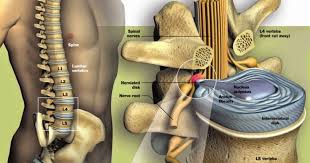 Slip disc adalah keadaan di mana intervertebral disc di tulang belakang memberi tekanan kepada saraf di spinal cord. Premium Beautiful Corset Murah 2020 Sakit Tulang Belakang Slip Disc