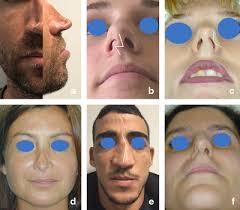 Esplorazioni fisiche e funzionali delle cavità nasali