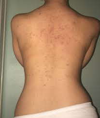 These 21 body washes deserve some real estate in your shower Acne Always Struggled With Back Acne And Brown Spots Acne Scars Please Help Skincareaddiction