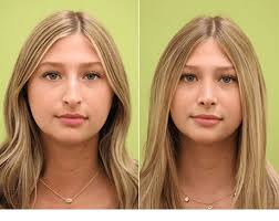 Avoid blowing your nose or removing any crusts until your appointment to have the splint removed sneeze through your mouth to avoid pressure on your nose Rhinoplasty Before After Mandeville La Slidell La Slent