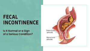 Image result for Fecal Incontinence