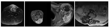 Image result for Leiomyosarcoma