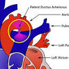 Transcatheter closure has become the treatment of choice for pda in children > 1 year, and some authors consider transcatheter outcomes after pda closure are excellent. Https Encrypted Tbn0 Gstatic Com Images Q Tbn And9gct9ygrhofn3zj0u8mvkcisvyep1bo4tzywjexyg9rght3qijhak Usqp Cau