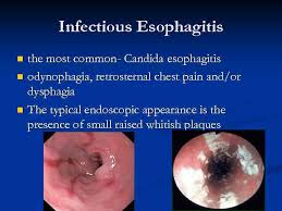 Eosinophilic esophagitis attributed to gastroesophageal re. Gastro Oesophageal Reflux Disease Gord Differential Diagnosis Gord