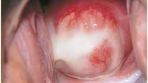 Your signs or symptoms return after treatment. Chlamydia Infection Symptoms Treatments Risk Factors
