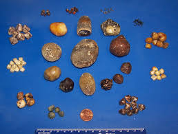Gallstones From A Pathological View