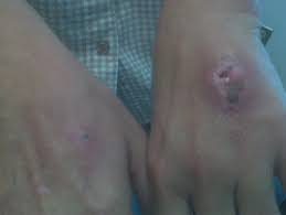 Because snakes have small, razor sharp fangs, the site of the wound may only have faint puncture marks (these could even look like a scratch). Dog And Cat Bites Concise Medical Knowledge