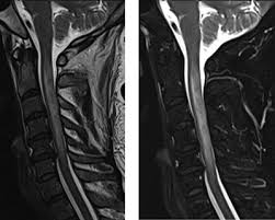 Image result for Myelitis