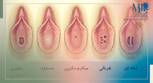 پرده بکارت ارتجاعی - 3 نکته مهم - دکتر مریم ابراهیمی لقا