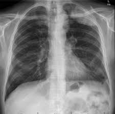 ‎~ 40 years after exposure to ‎ asbestos treatment‎: Multiple Distant Metastases In A Case Of Malignant Pleural Mesothelioma Sciencedirect