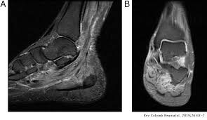 Foot positioned for axial images of the ankles; Multifocal Myopathy In A Patient With Polyarteritis Nodosa Usefulness Of Magnetic Nuclear Resonance As A Diagnostic Test Revista Colombiana De Reumatologia English Edition
